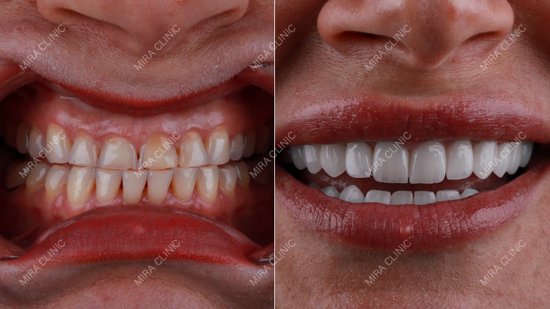 Before and After Hollywood Smile Journey